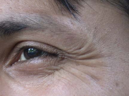 Crow’s-feet lines at the outer corner of the eye