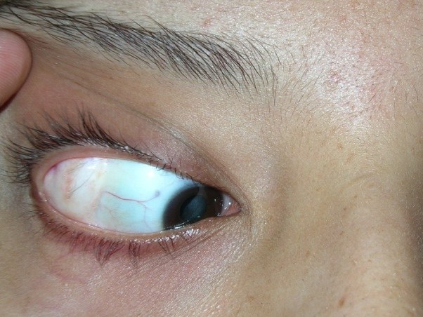 Dermolipoma on the outer white of the eye