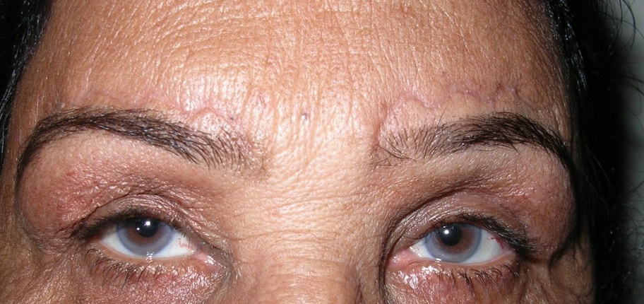Browplasty, after