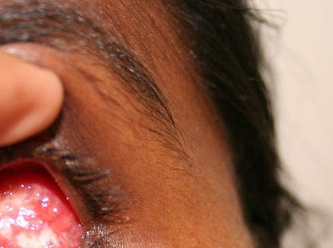 Contracted Socket Reconstruction, 4 weeks after surgery (DFG well taken up)