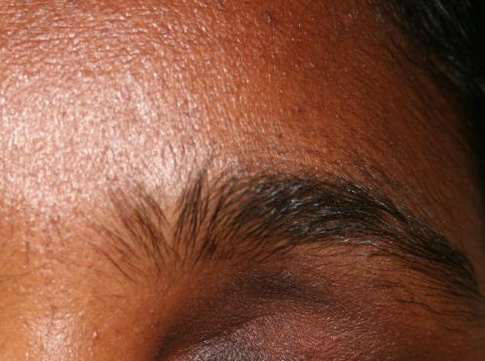Contracted Socket Reconstruction, 6 weeks after surgery