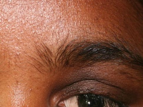 Contracted Socket Reconstruction, custom prosthesis, well retained