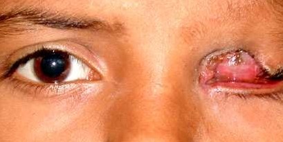 Cryptophthalmos, before