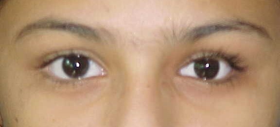 Custom Artificial Eye, after