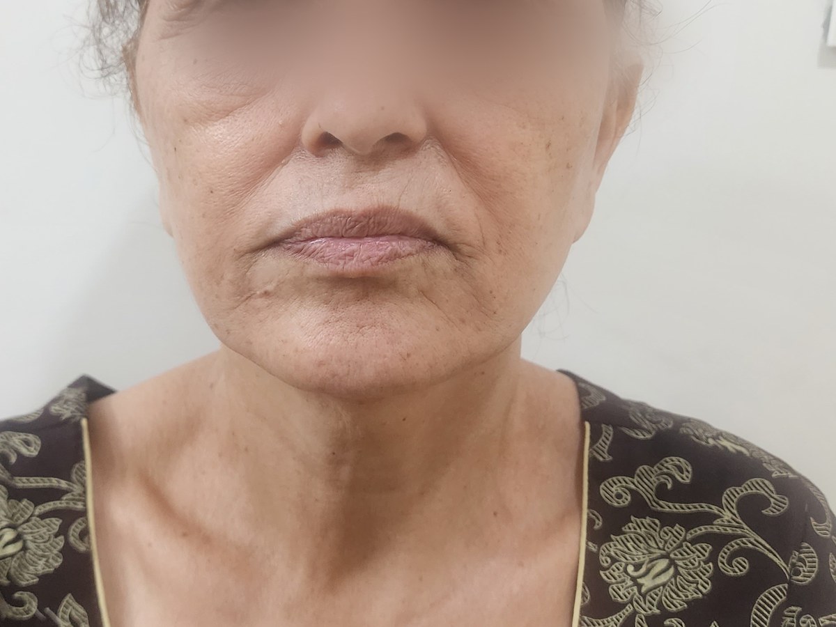 Face Lift, after
