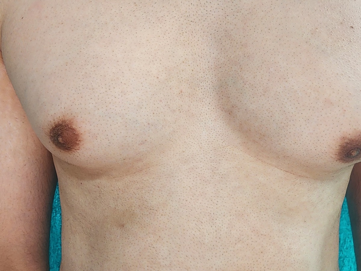 Gynecomastia, before
