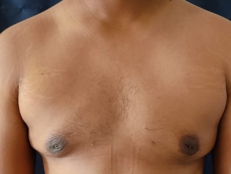 Gynecomastia, after