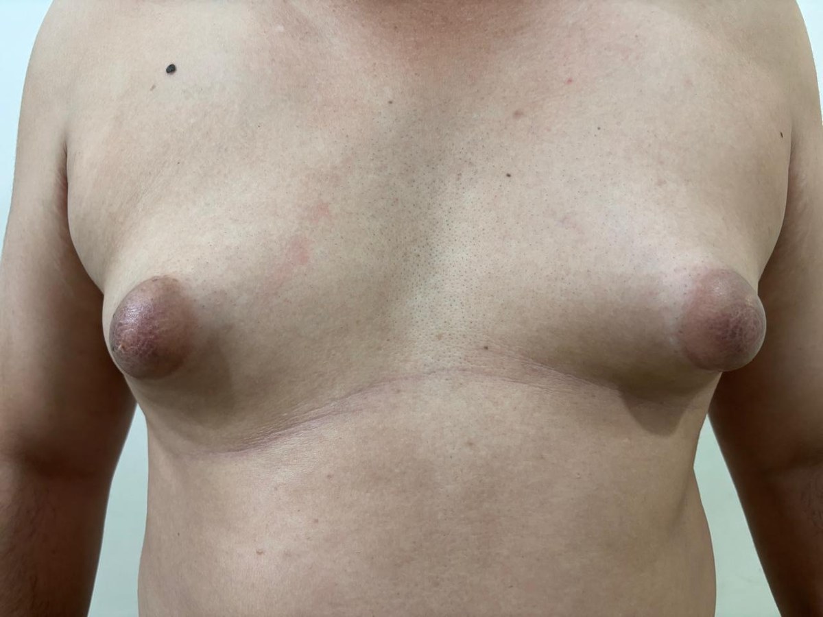 Gynecomastia, before