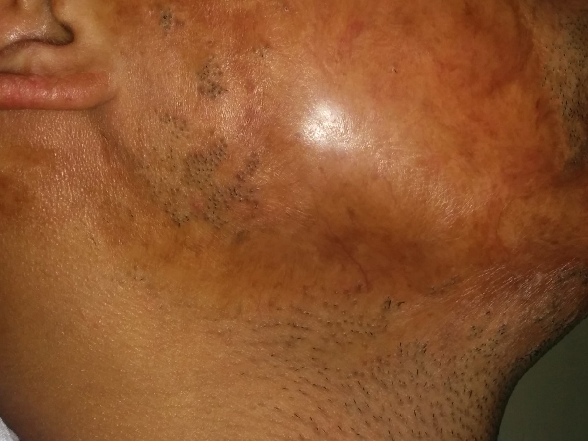Beard Hair Transplant, before