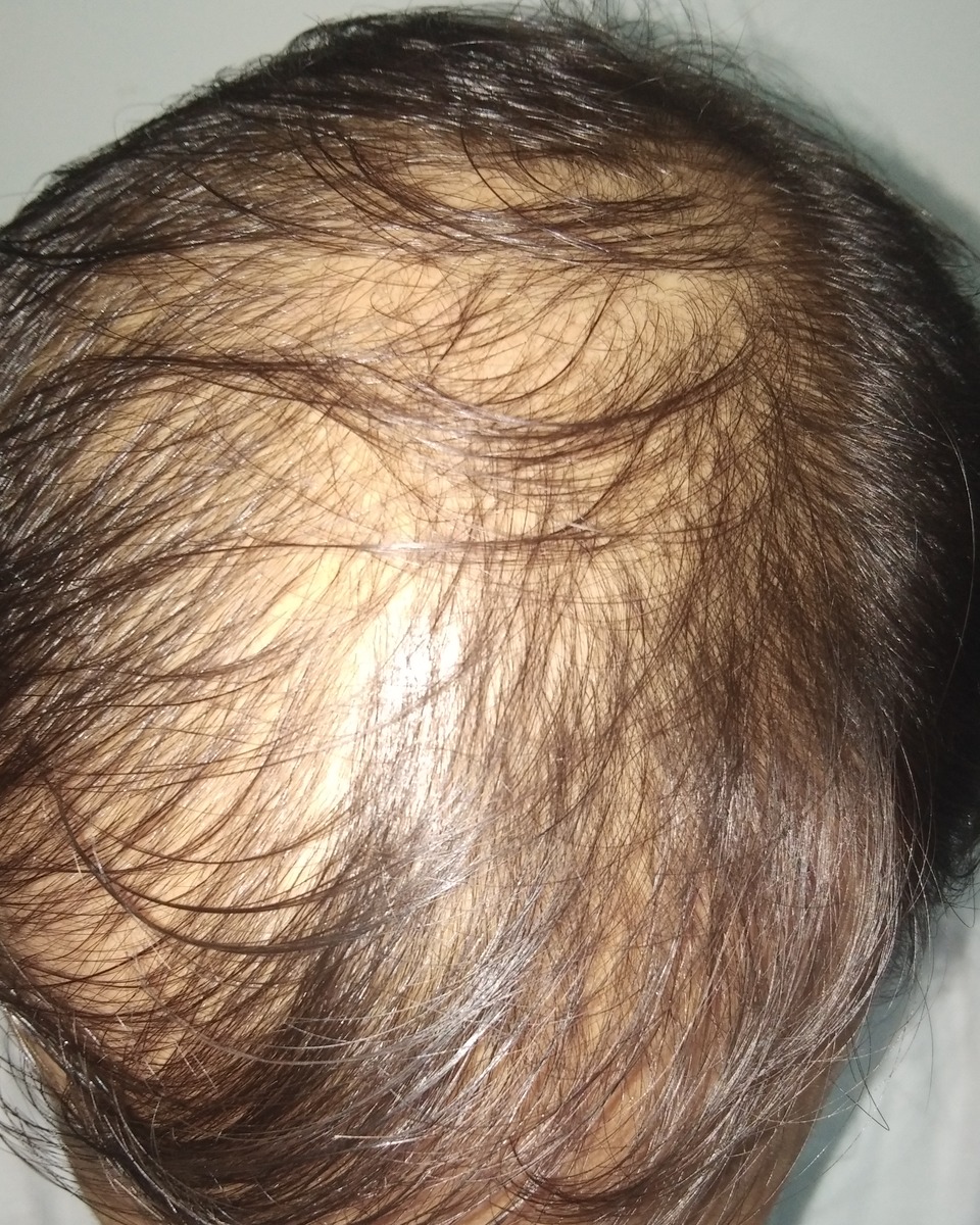 Hair Transplant, before