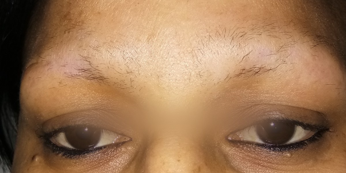 Eyebrow Hair Transplant, before