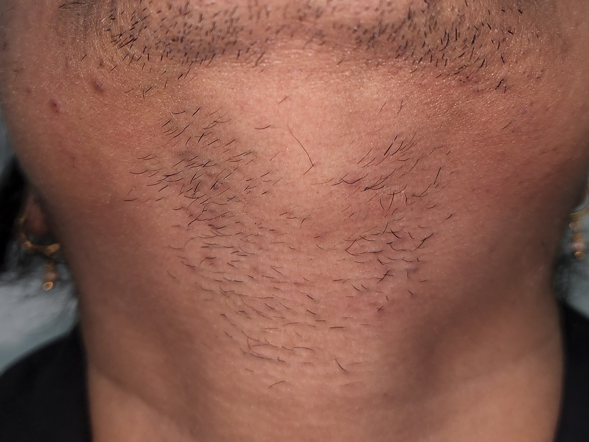 Laser Hair Removal, before