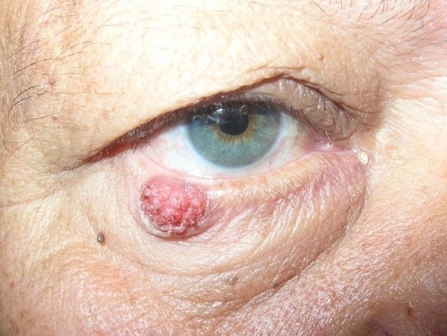 Lid Tumor, before