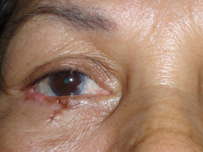 Lid Tumor, after