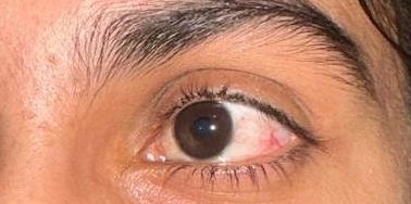 Conjunctival Nevus, after