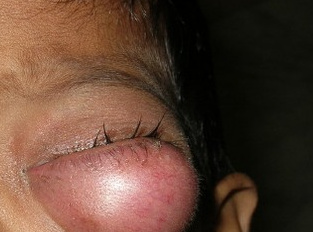 Orbital Abscess, before treatment