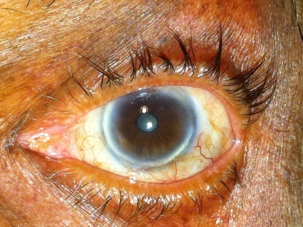 OSSN — Excision with Limbal Stem Cell Transplant, after