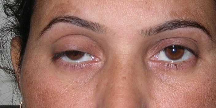 Ptosis — LPS Plication, before