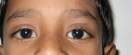 Ptosis — Tarso-Frontal Sling, after