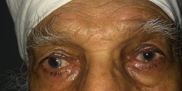 Ptosis, after