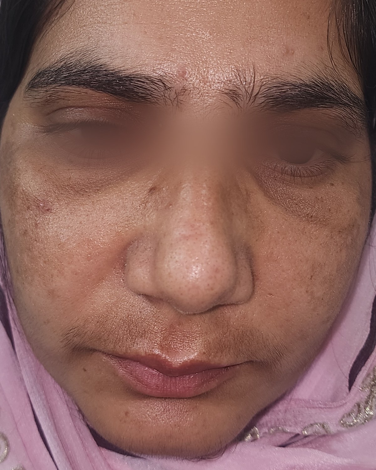 Rhinoplasty, after
