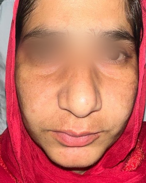 Rhinoplasty, before