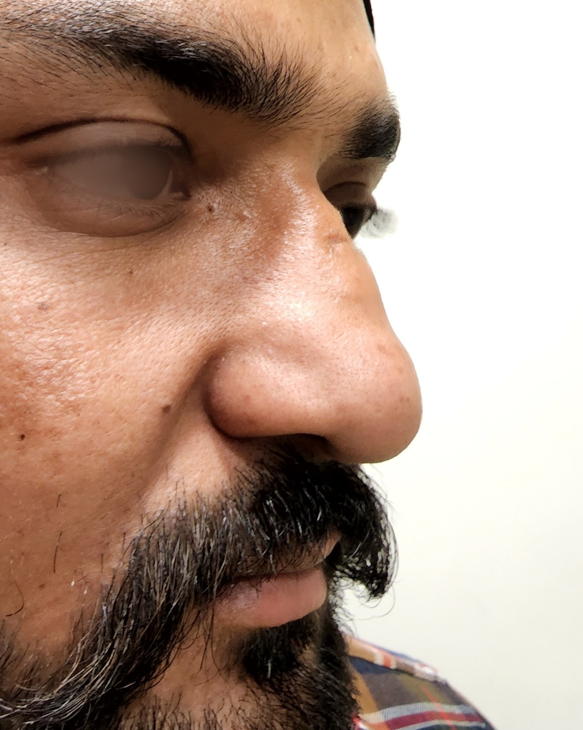 Rhinoplasty, before