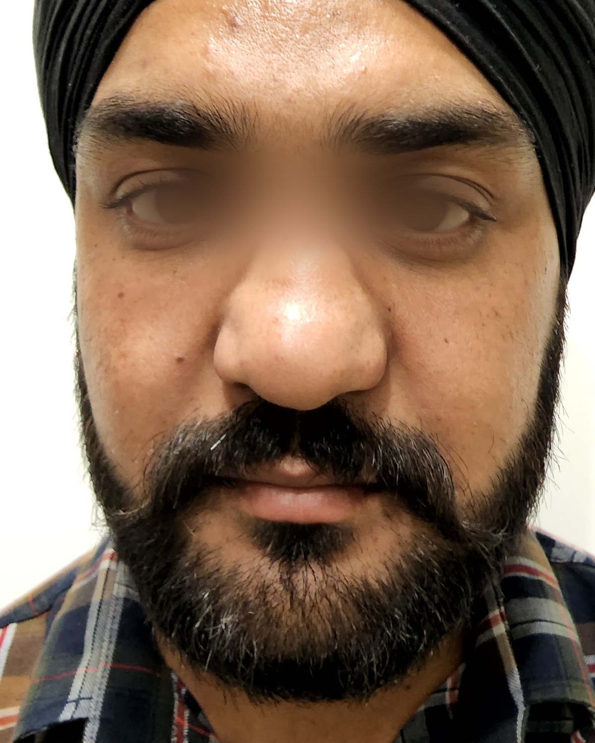 Rhinoplasty, before