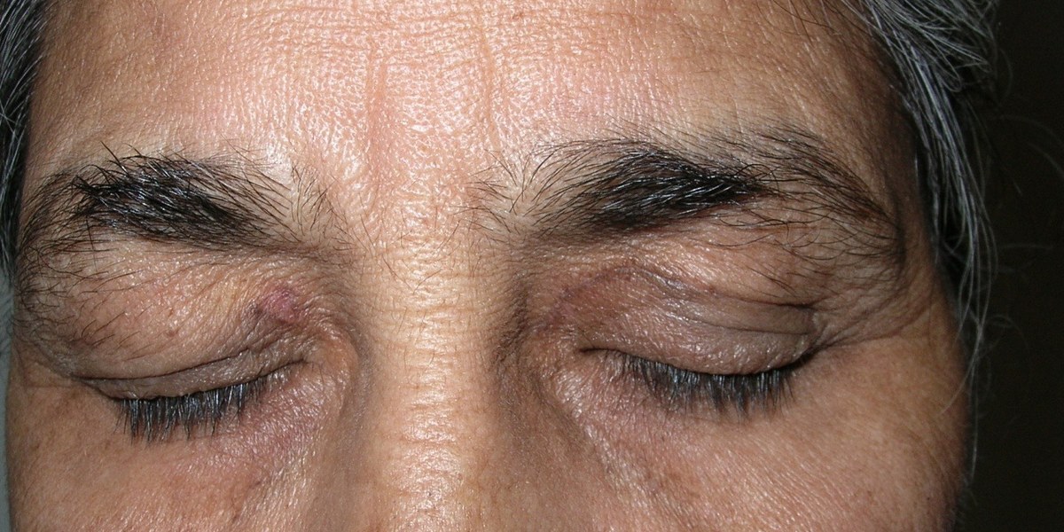 Xanthelasma, after